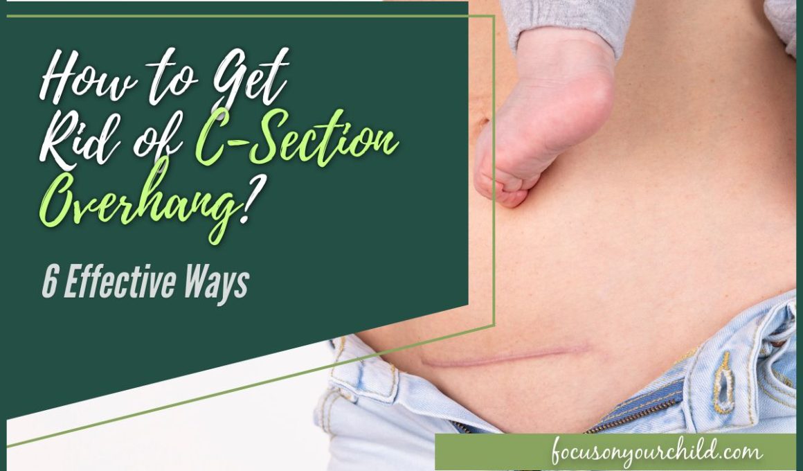 How to Get Rid of C-Section Overhang 6 Effective Ways