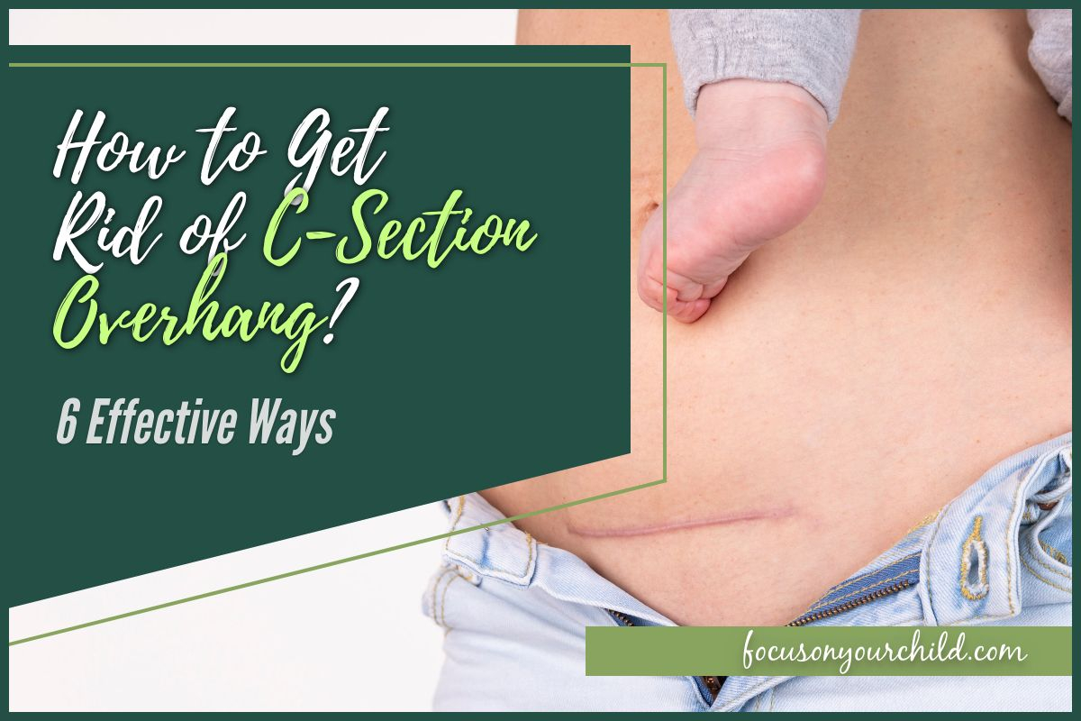 How To Get Rid Of C Section Overhang 6 Effective Ways printable-exercises-for-abs
