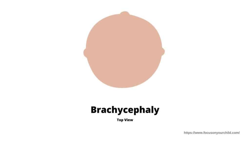 brachycephaly