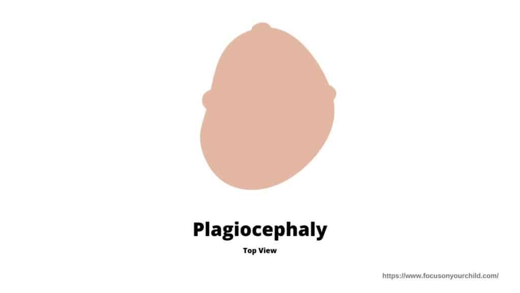 plagiocephaly