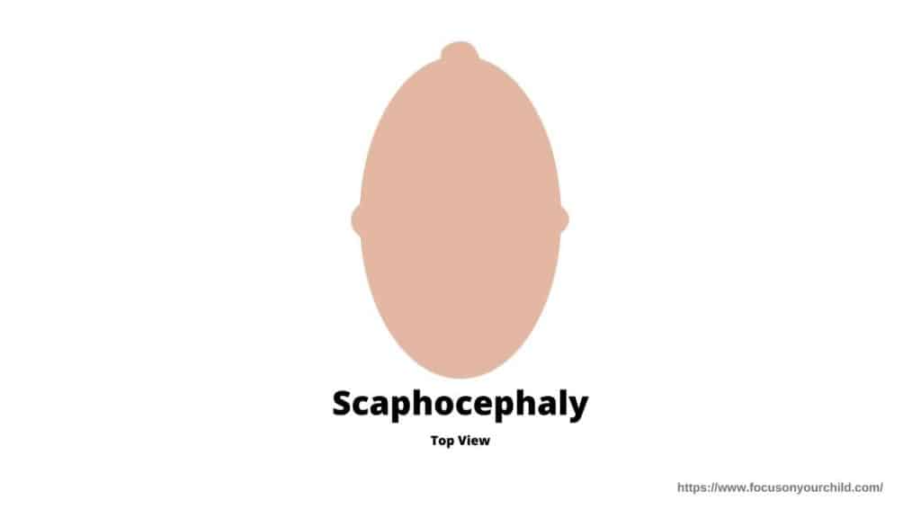scaphocephaly