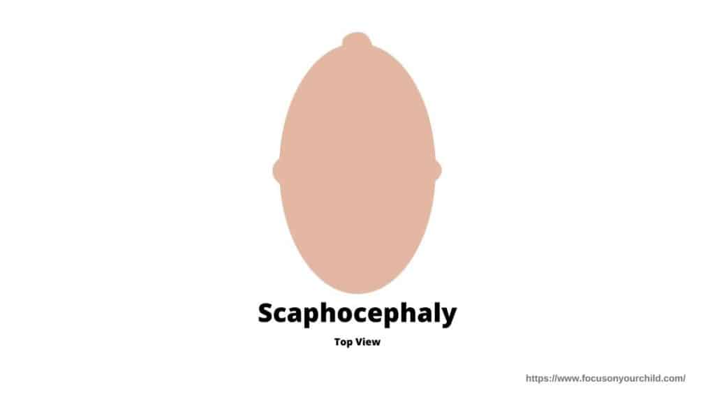 scaphocephaly