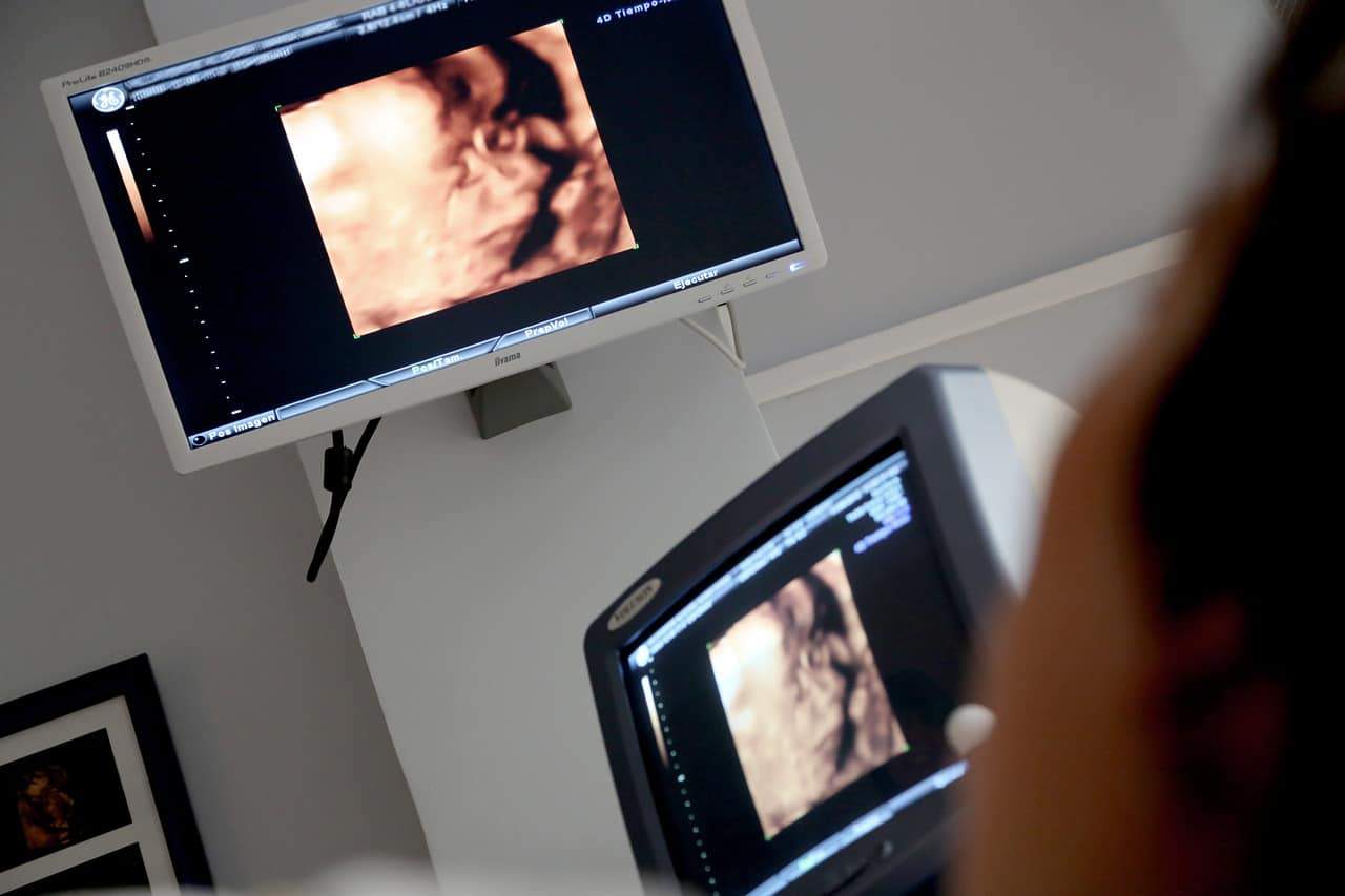 monitor ultrasound