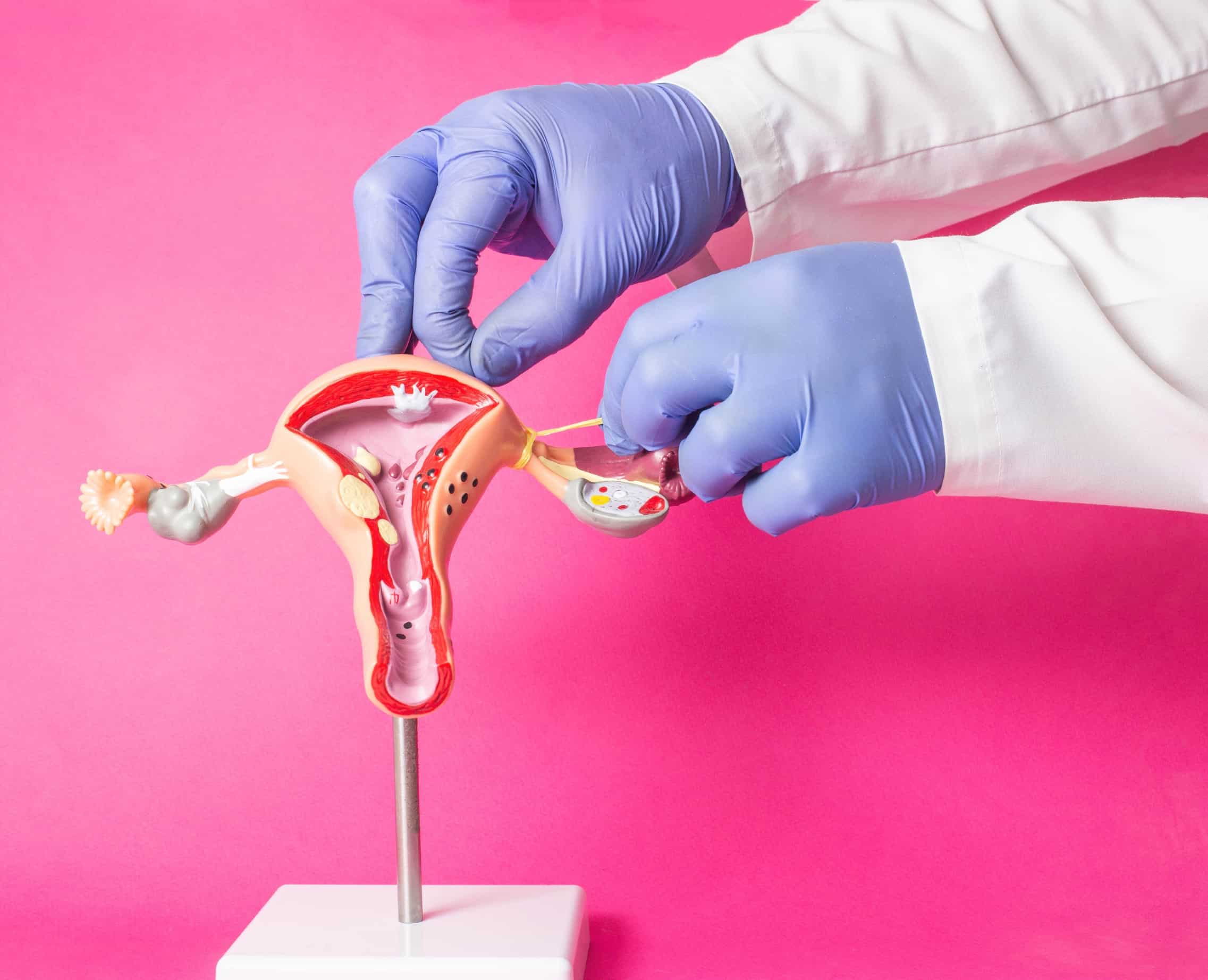 gynecologist demonstrating tubal ligatiion