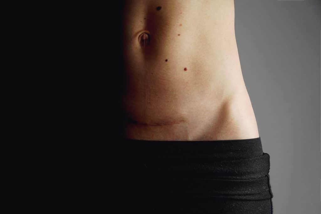 3 Ways To Deal With Ingrown Hairs On C Section Scars