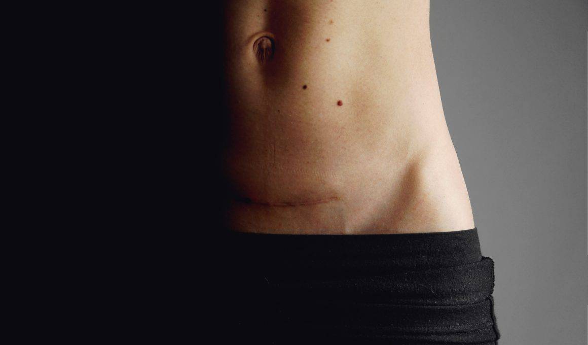 woman with c section scar