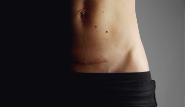 woman with c section scar