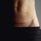 woman with c section scar